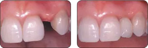 Before and After Hillsborough Dentist Dr. Sinha adds a dental implant